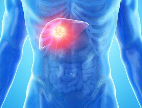 Гепатобластома: новая информация для специалистов